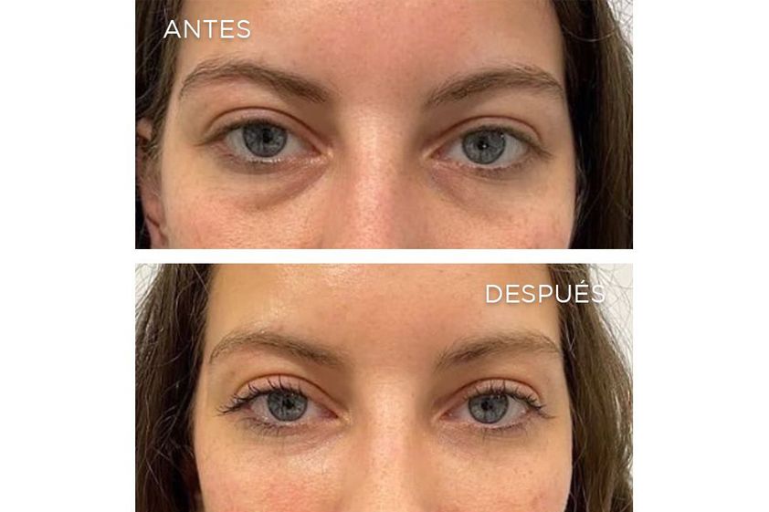 Eliminación ojeras antes y después - 867265