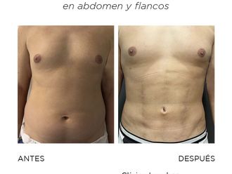 Lipo Vaser antes y después - 867269