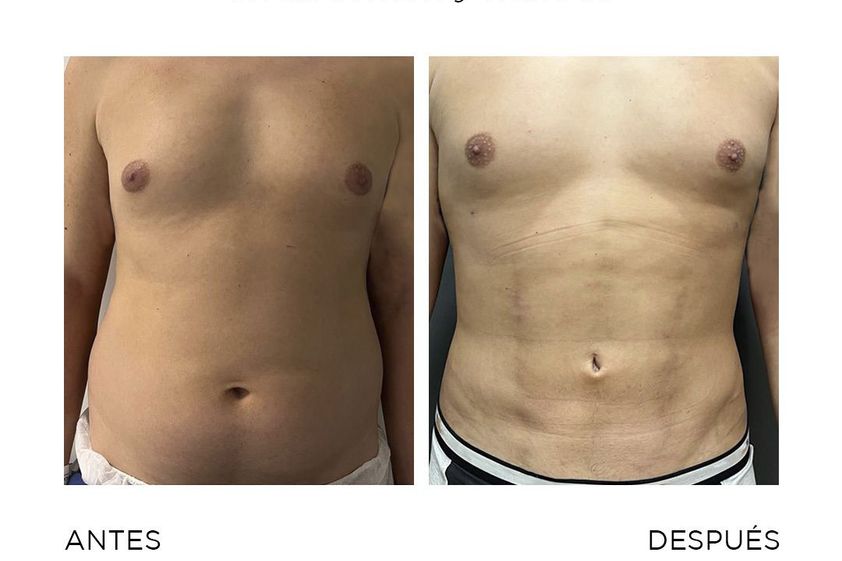 Lipo Vaser antes y después - 867269