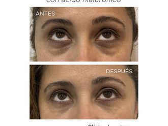 Eliminación ojeras antes y después - 867545