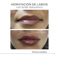 Hidratación de labios con Ácido Hialurónico - Clínica Londres