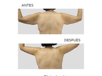 Liposucción antes y después - 867586