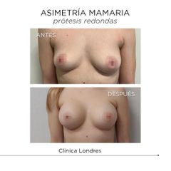 Asimetría mamaria - Clínica Londres