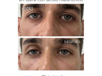 Eliminación ojeras antes y después - 868223