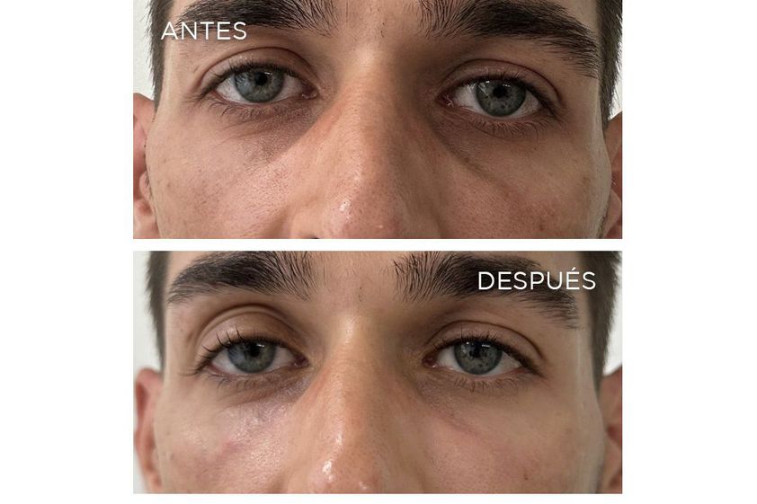 Eliminación ojeras antes y después - 868223