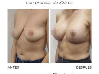 Mastopexia antes y después - 868227