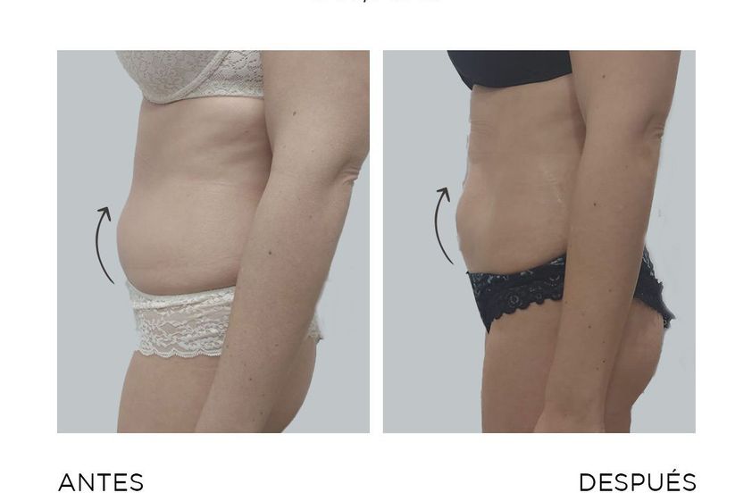 Liposucción antes y después - 868406