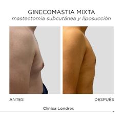 Ginecomastia - Clínica Londres