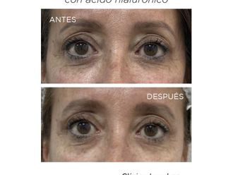 Eliminación ojeras antes y después - 868408