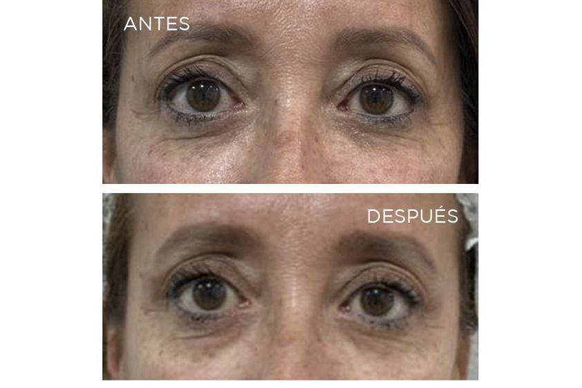 Eliminación ojeras antes y después - 868408