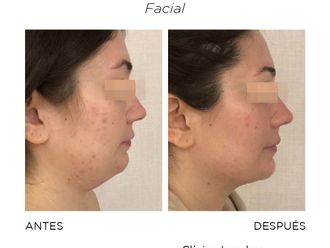 Mesoterapia antes y después - 868410