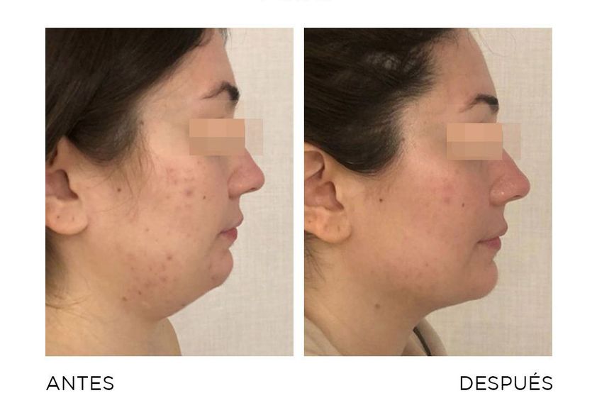 Mesoterapia antes y después - 868410