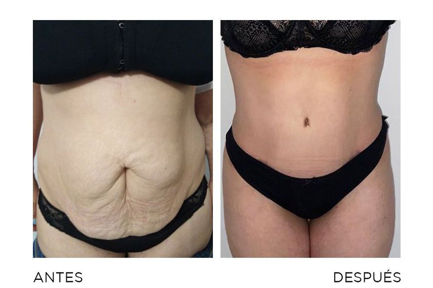 Abdominoplastia antes y después - 868413