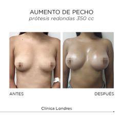 Aumento de pecho - Clínica Londres