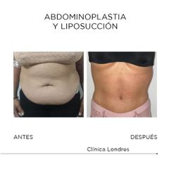 Abdominoplastia y liposucción - Clínica Londres