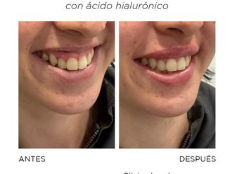 Aumento labios antes y después - 870096