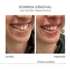 Sonrisa gingival - Clínica Londres