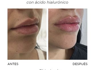 Aumento labios antes y después - 870097