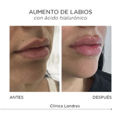 Aumento de labios - Clínica Londres