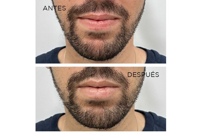Ácido hialurónico antes y después - 870099