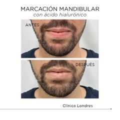 Marcación mandibular - Clínica Londres