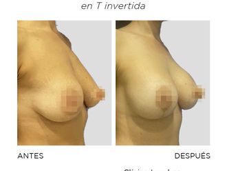 Mastopexia antes y después - 870100