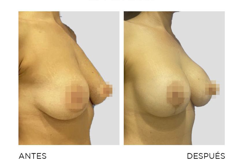 Mastopexia antes y después - 870100