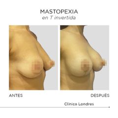 Mastopexia - Clínica Londres