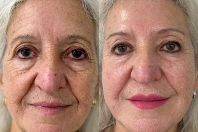 Rejuvenecimiento facial antes y después - 877653