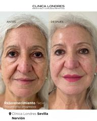 FULL FACE: rejuvenecimiento facial sin cirugía