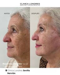 FULL FACE: Rejuvenecimiento facial