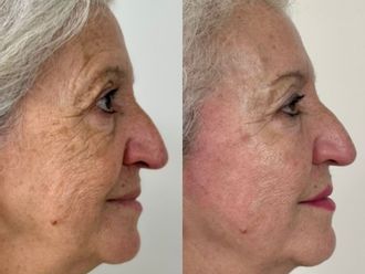 Rejuvenecimiento facial antes y después - 877655