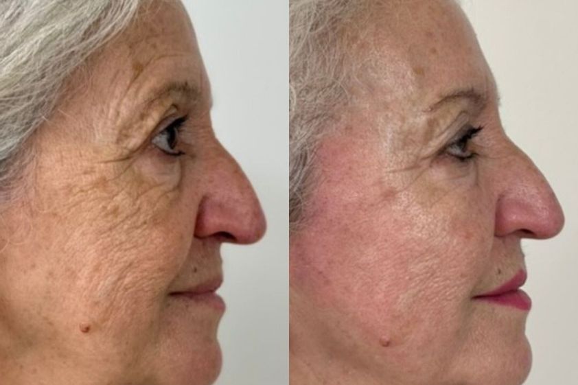Rejuvenecimiento facial antes y después - 877655
