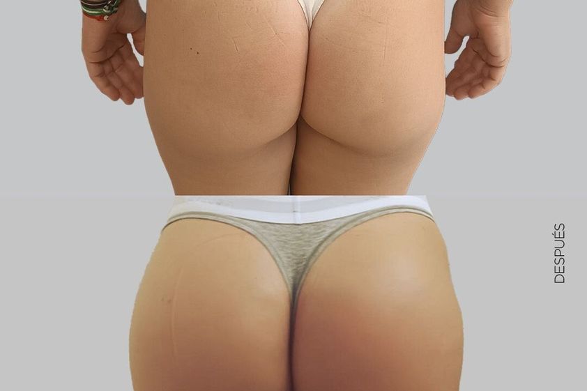 Aumento glúteos antes y después - 877656