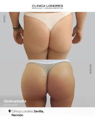 Gluteoplastia con LipoVASER- Clínica Londres