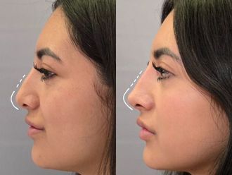 Rinomodelación antes y después - 877657