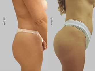 Aumento glúteos antes y después - 877658
