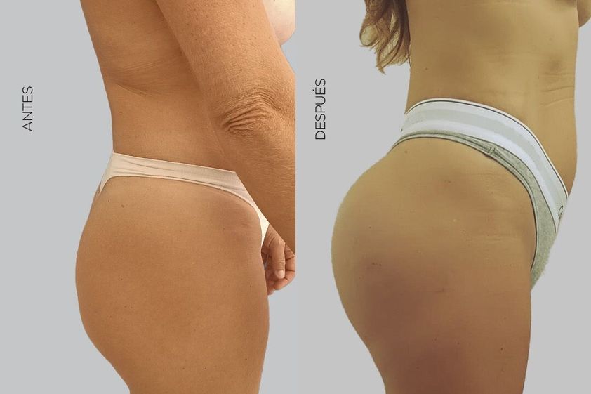 Aumento glúteos antes y después - 877658