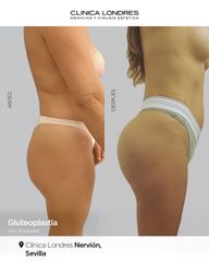 Gluteoplastia con LipoVASER- Clínica Londres