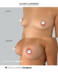 Aumento de pecho con prótesis