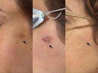 Peeling antes y después - 878090