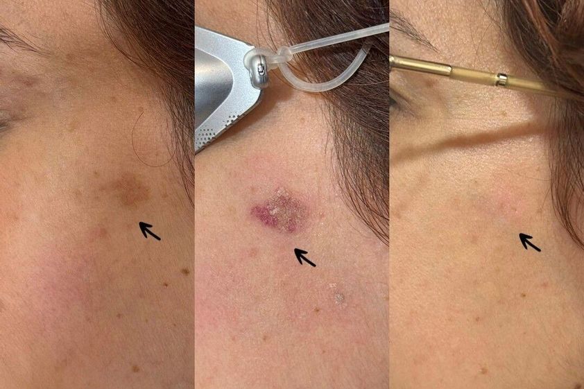 Peeling antes y después - 878090