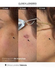 Eliminación de manchas