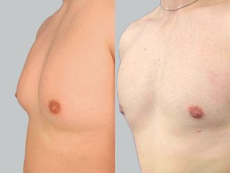 Ginecomastia antes y después - 878157