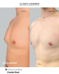Ginecomastia