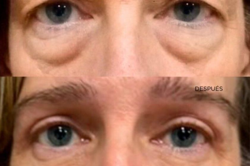 Blefaroplastia antes y después - 878158