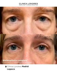 Blefaroplastia completa