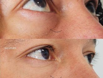 Eliminación ojeras antes y después - 878356