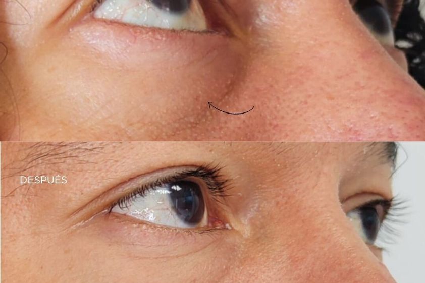 Eliminación ojeras antes y después - 878356