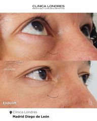 Antes y despues Eliminar bolsas con Endolift